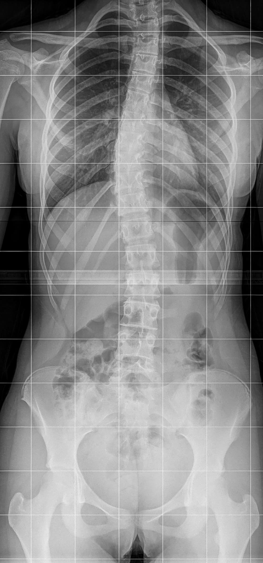 Scoliosis – spinal X-ray, figure 1